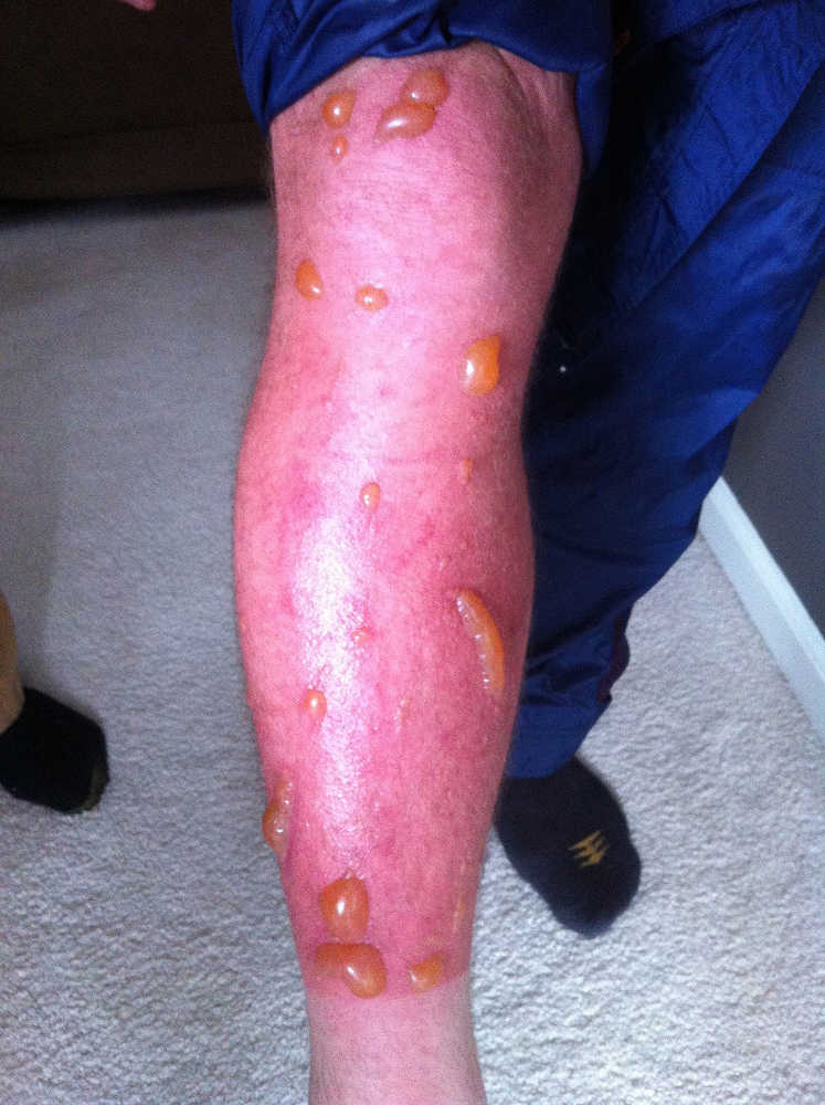 Photo provided by Matthew Waliszek Severe blisters plagued the legs of Matthew Waliszek after coming across the pushki plant on a 2013 training run on the Crow Pass trail.