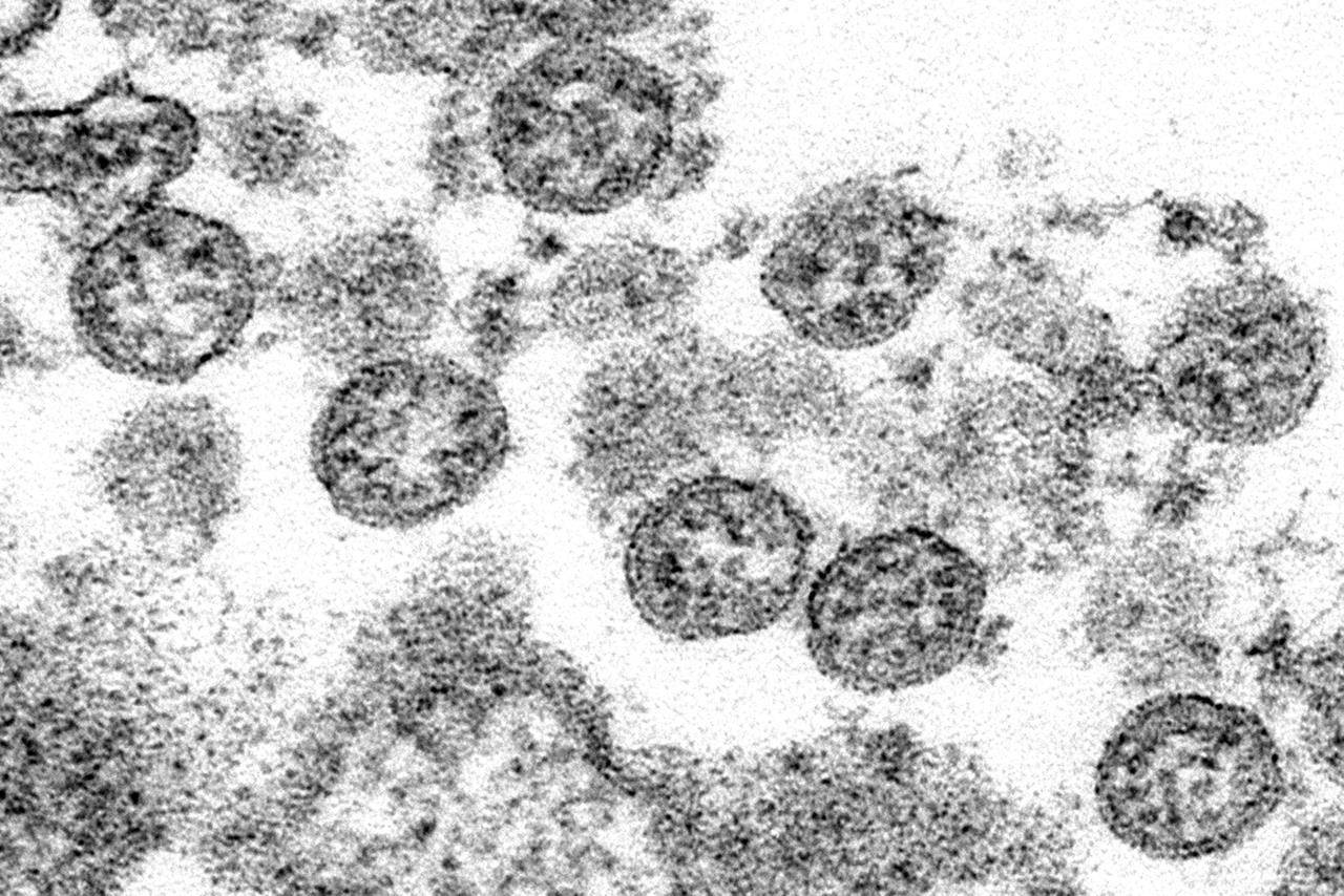 This 2020 electron microscope made available by the U.S. Centers for Disease Control and Prevention image shows the spherical coronavirus particles from the first U.S. case of COVID-19. THE CANADIAN PRESS/AP-C.S. Goldsmith, A. Tamin/ CDC via AP