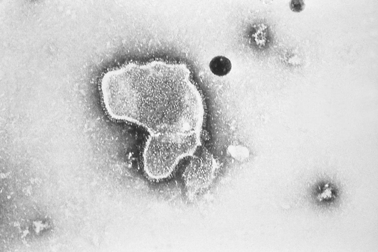 This 1981 photo provided by the Centers for Disease Control and Prevention (CDC) shows an electron micrograph of Respiratory Syncytial Virus, also known as RSV. Children’s hospitals in parts of the country are seeing a distressing surge in RSV, a common respiratory illness that can cause severe breathing problems for babies. Cases fell dramatically two years ago as the pandemic shut down schools, day cares and businesses. Then, with restrictions easing, the summer of 2021 brought an alarming increase in what is normally a fall and winter virus. (CDC via AP)