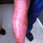 Photo provided by Matthew Waliszek Severe blisters plagued the legs of Matthew Waliszek after coming across the pushki plant on a 2013 training run on the Crow Pass trail.